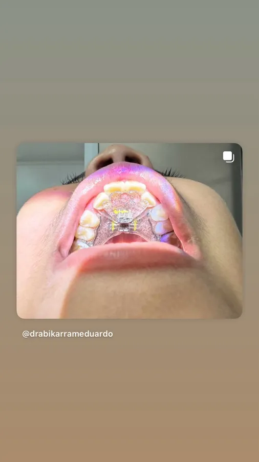 Expansor tipo Haas