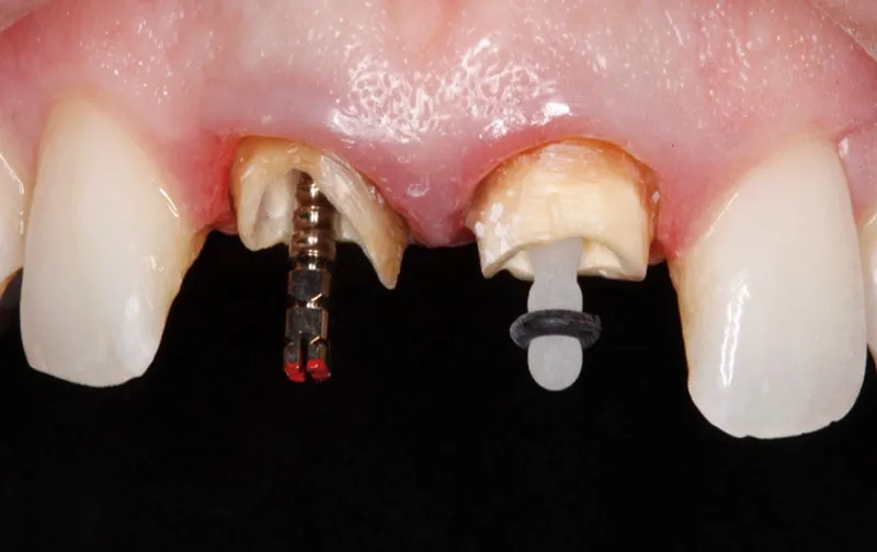 Pernos dentales