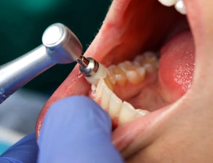 Limpieza dental