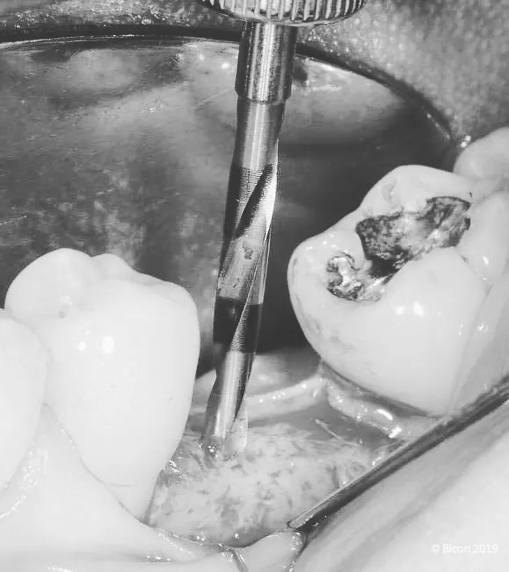 Implantes dentales