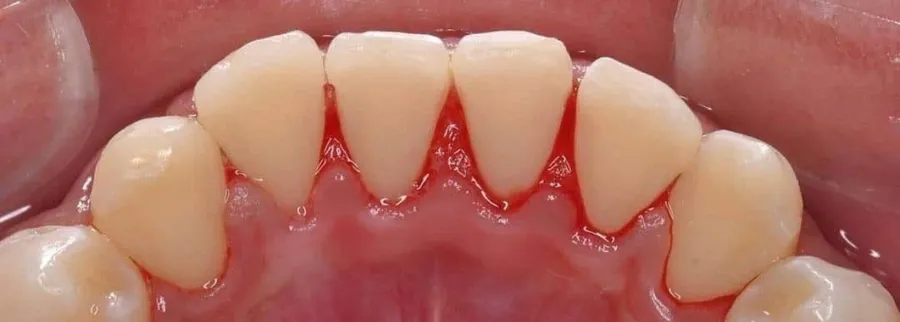 Periodoncia